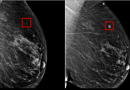 AI Detects Breast Cancer 4 Years before it develops