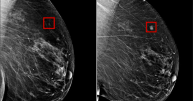 AI Detects Breast Cancer 4 Years before it develops
