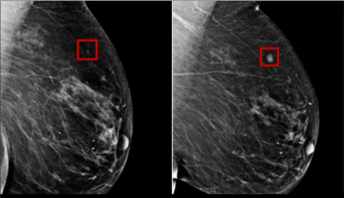 AI Detects Breast Cancer 4 Years before it develops