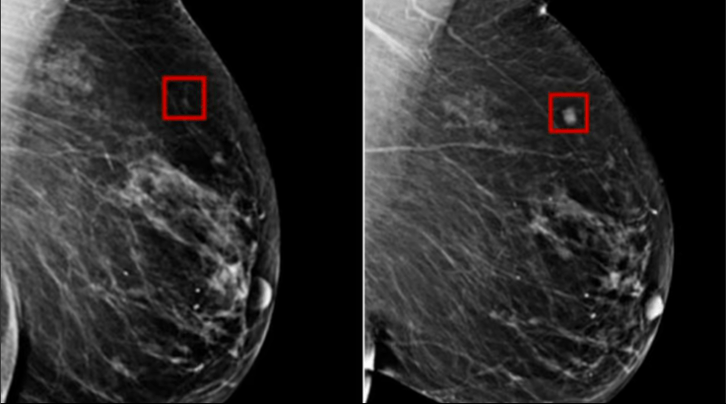 AI Detects Breast Cancer 4 Years before it develops